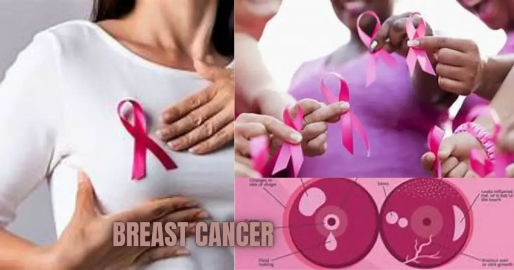 Breast Cancer